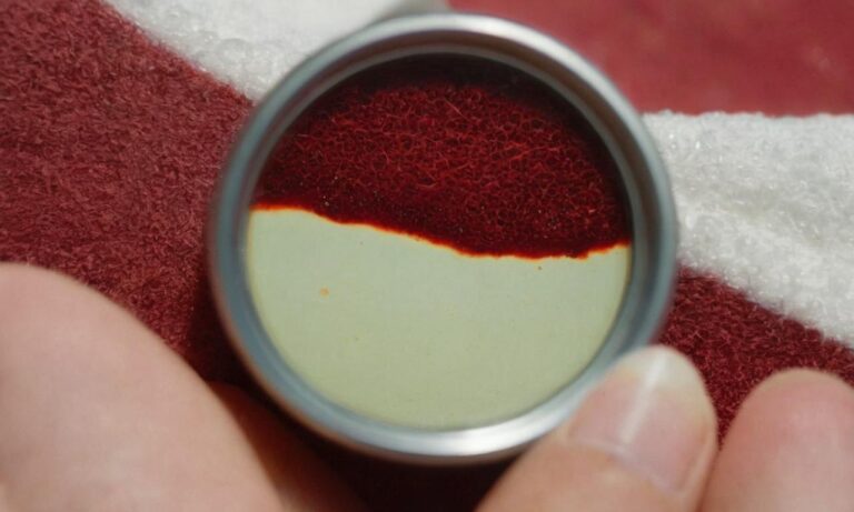 Co to jest łojotokowe zapalenie skóry głowy